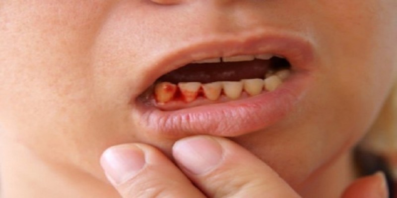 Mộng thấy gãy răng chảy máu